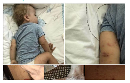 Украину охватил вирус Коксаки: пути передачи и способы защиты 4