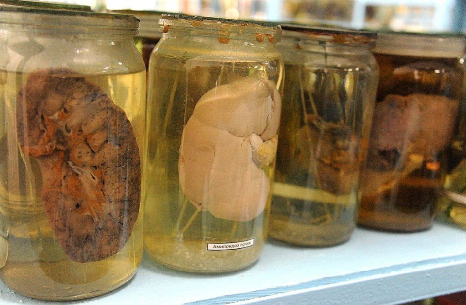 Почки, законсервированные в формалине Почки, законсервированные в формалине