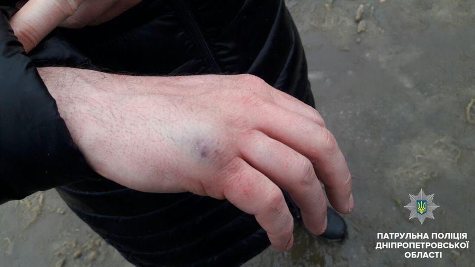 По предварительной информации, пострадавший получил перелом кисти и черепно-мозговую травму По предварительной информации, пострадавший получил перелом кисти и черепно-мозговую травму