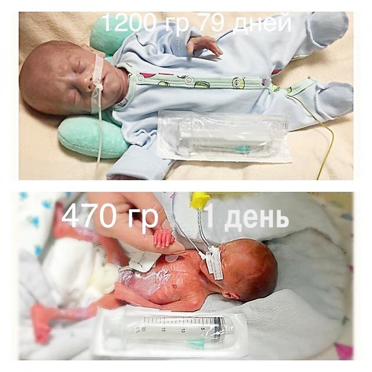 В Днепре зафиксировали рекорд: родился самый крохотный малыш В Днепре зафиксировали рекорд: родился самый крохотный малыш