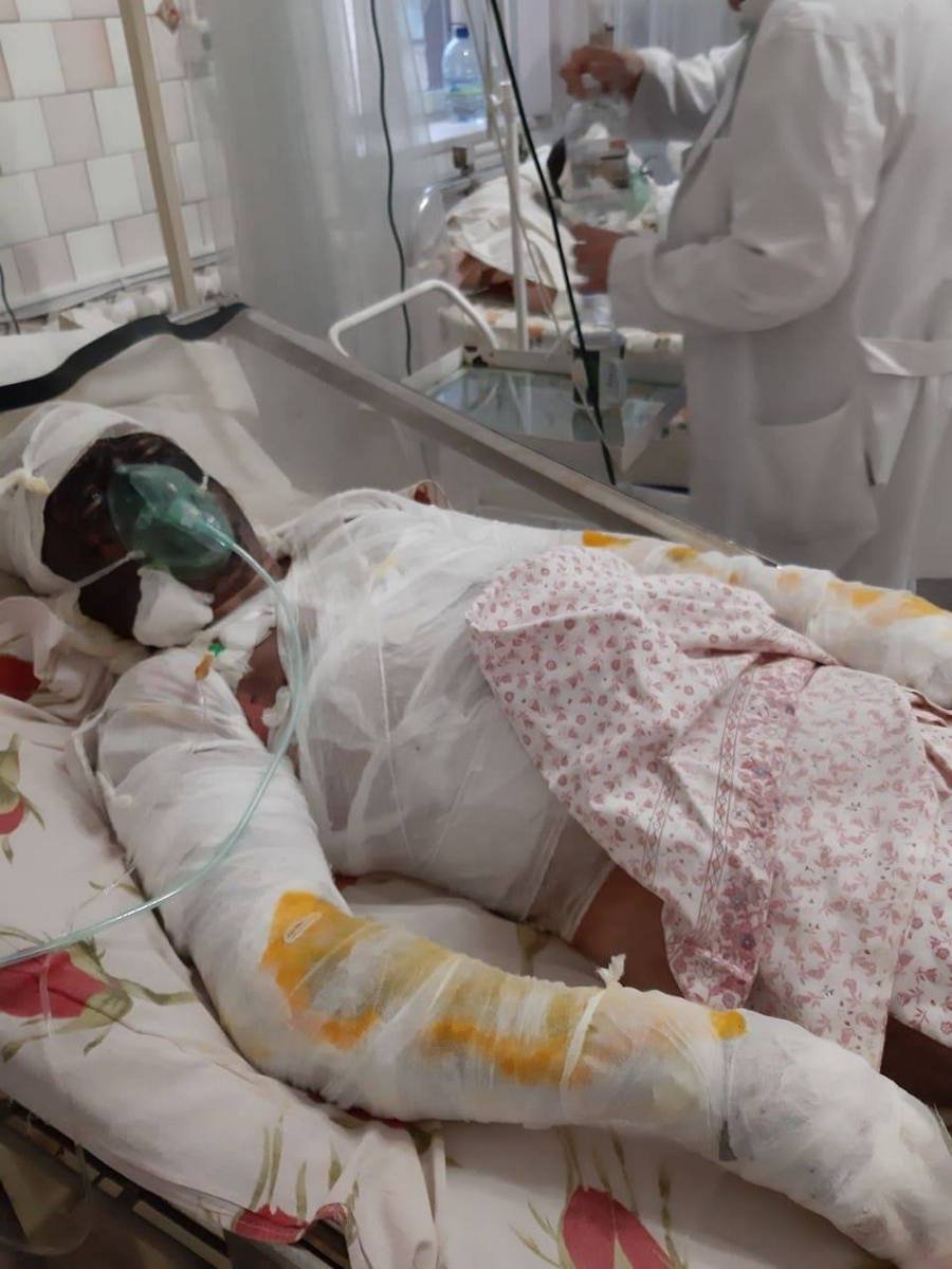 Ожоги поразили более 60% тела мужчины Ожоги поразили более 60% тела мужчины