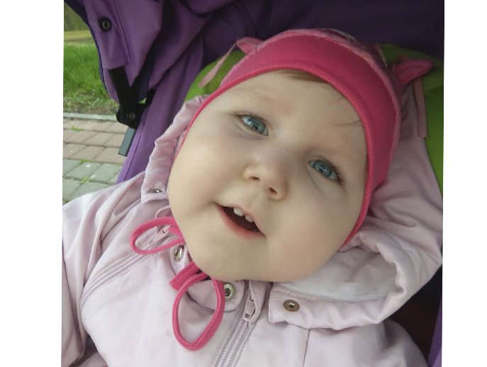 У девочки тяжелая форма эпилепсии 