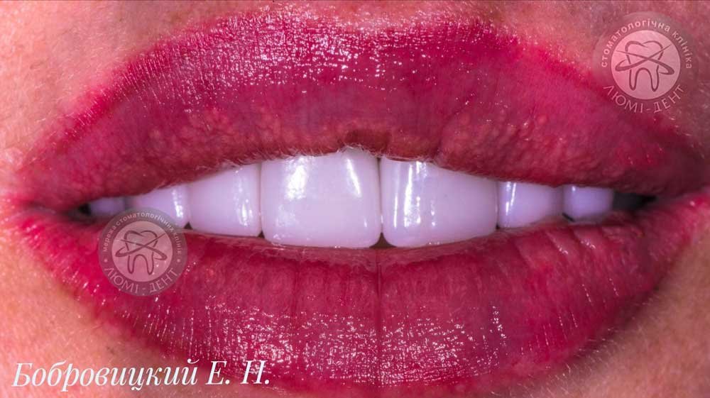 Виниры на зубы – ослепительная улыбка на всю жизнь 1