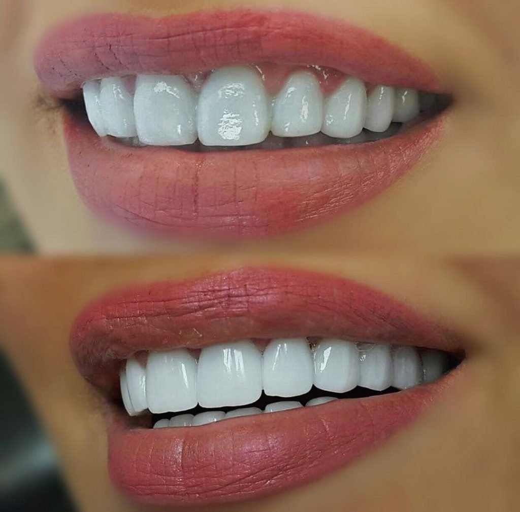 Виниры на зубы – ослепительная улыбка на всю жизнь 2