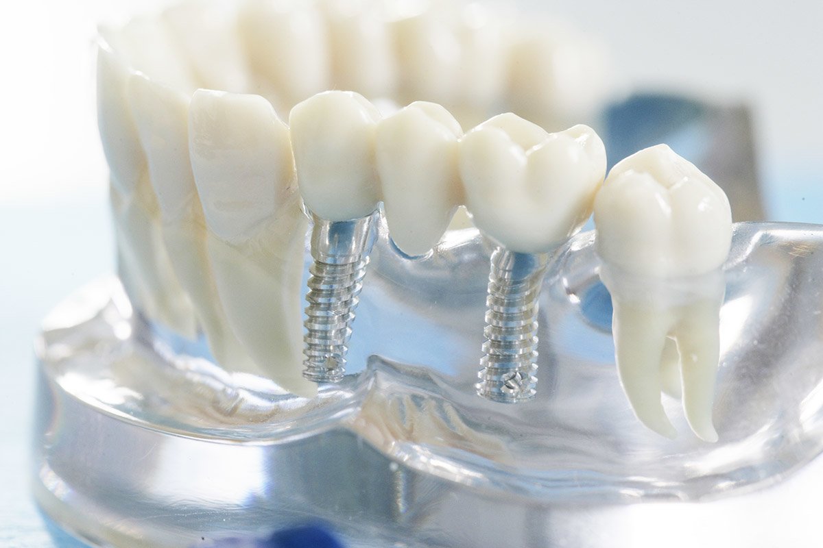 Имплантация зубов в Харькове: Премиум сервис услуги 1