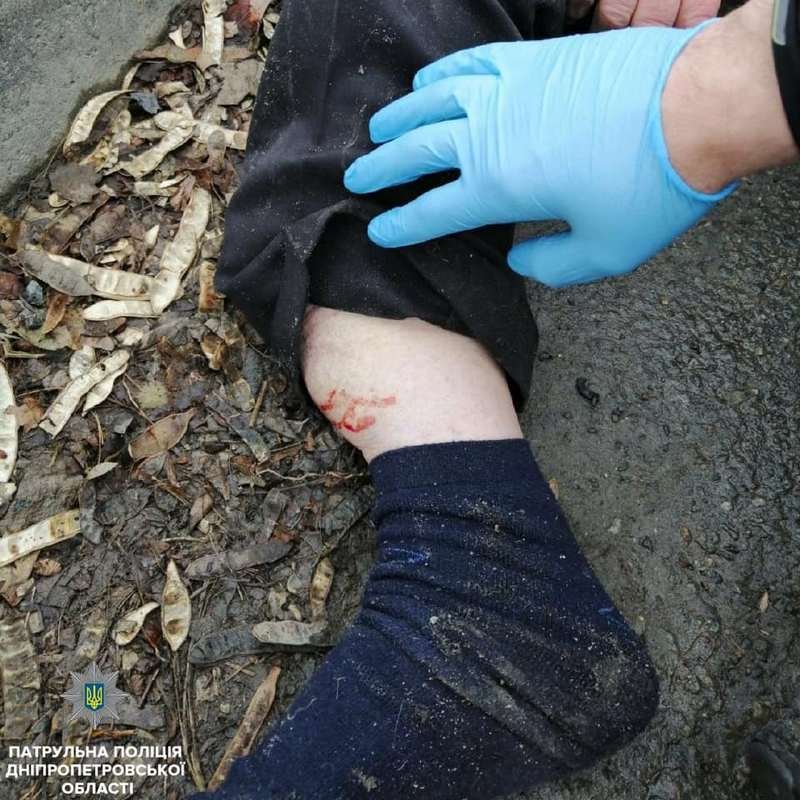 Сломал ногу Сломал ногу