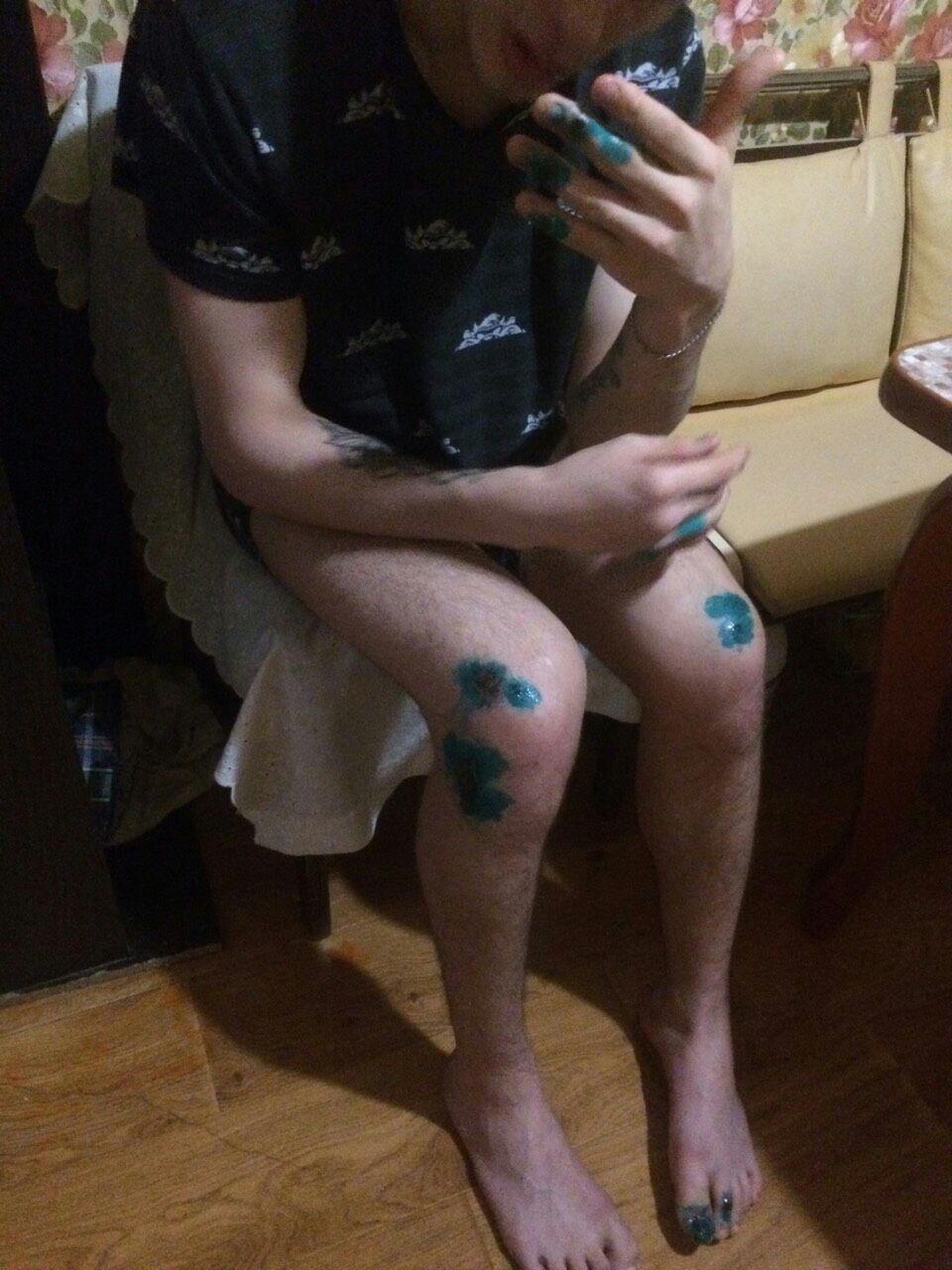 Сейчас парень продолжает лечиться дома Сейчас парень продолжает лечиться дома