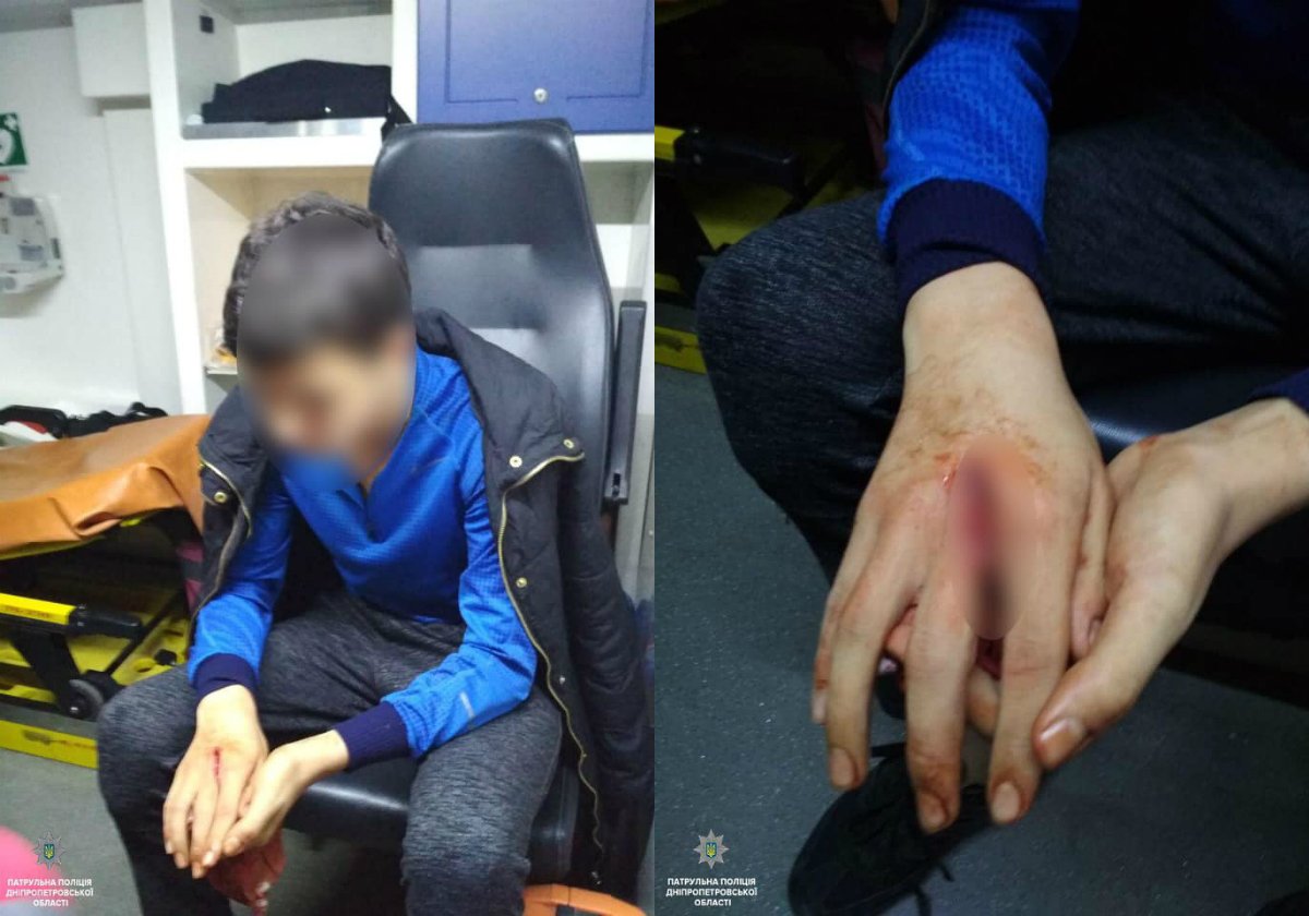 32-летний мужчина ударил сына по руке мачете 32-летний мужчина ударил сына по руке мачете