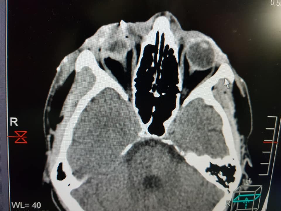 Тяжелое минно-взрывное ранение, проникающее ранение правого глаза, осколочные ранения лица, конечностей
