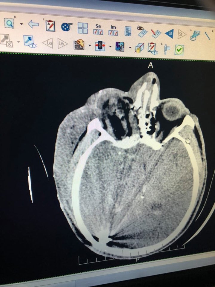 Начинается нейрохирургическое вмешательство