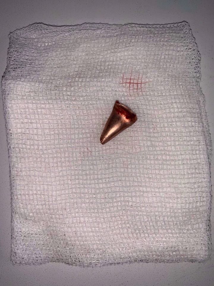 Пуля пробила глаз Александру, прошла через срединные структуры головного мозга и остановилась у затылочной кости черепа