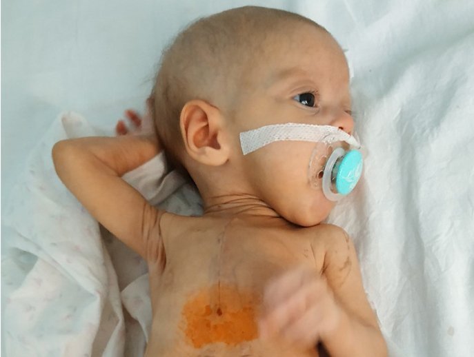 Девочке сделали сложную операцию на сердце 