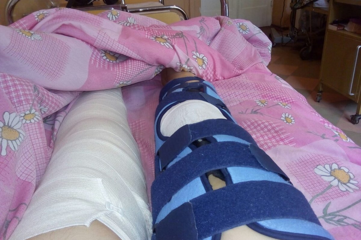 У 28-летней девушки сломаны обе ноги У 28-летней девушки сломаны обе ноги