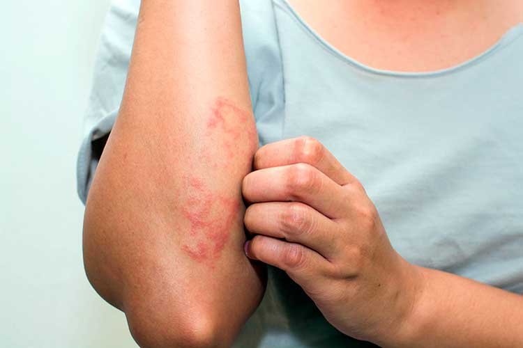 Экзема Экзема