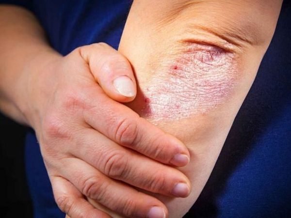 Псориаз Псориаз