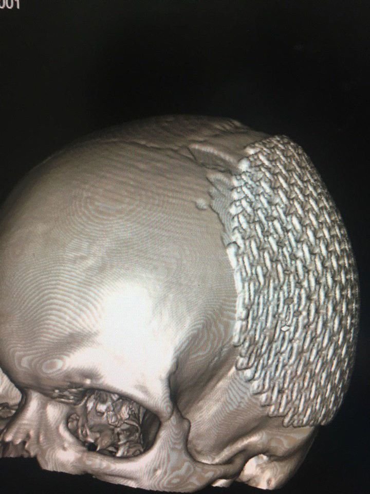 В Днепре спасли бойца, у которого разрушено 20% мозга