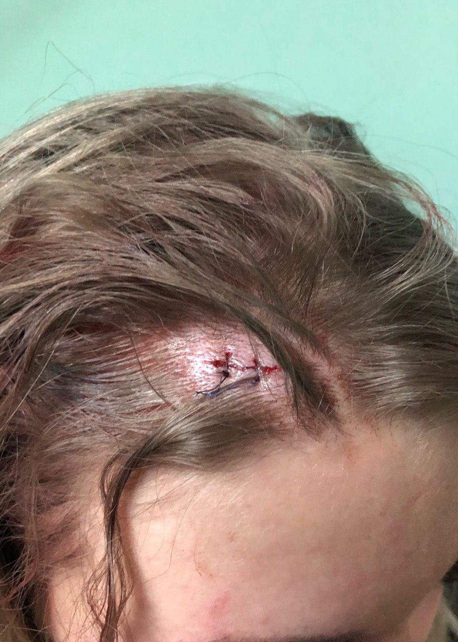 Девушке пришлось наложить швы Девушке пришлось наложить швы