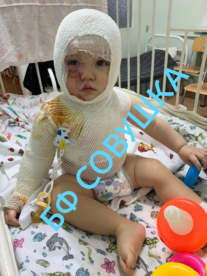 В Днепре на годовалого ребенка упал чайник с кипятком: нужна помощь 1