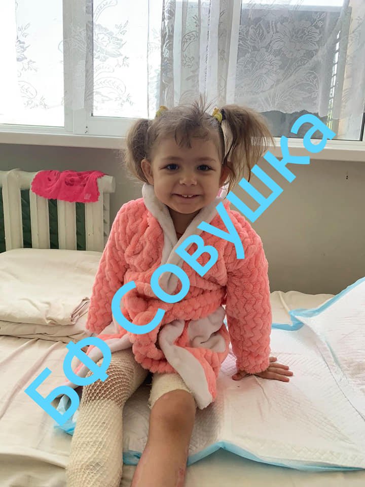 Как себя чувствует 3-летняя девочка, которая упала в ведро с кипятком в Днепре и получила ожоги 1