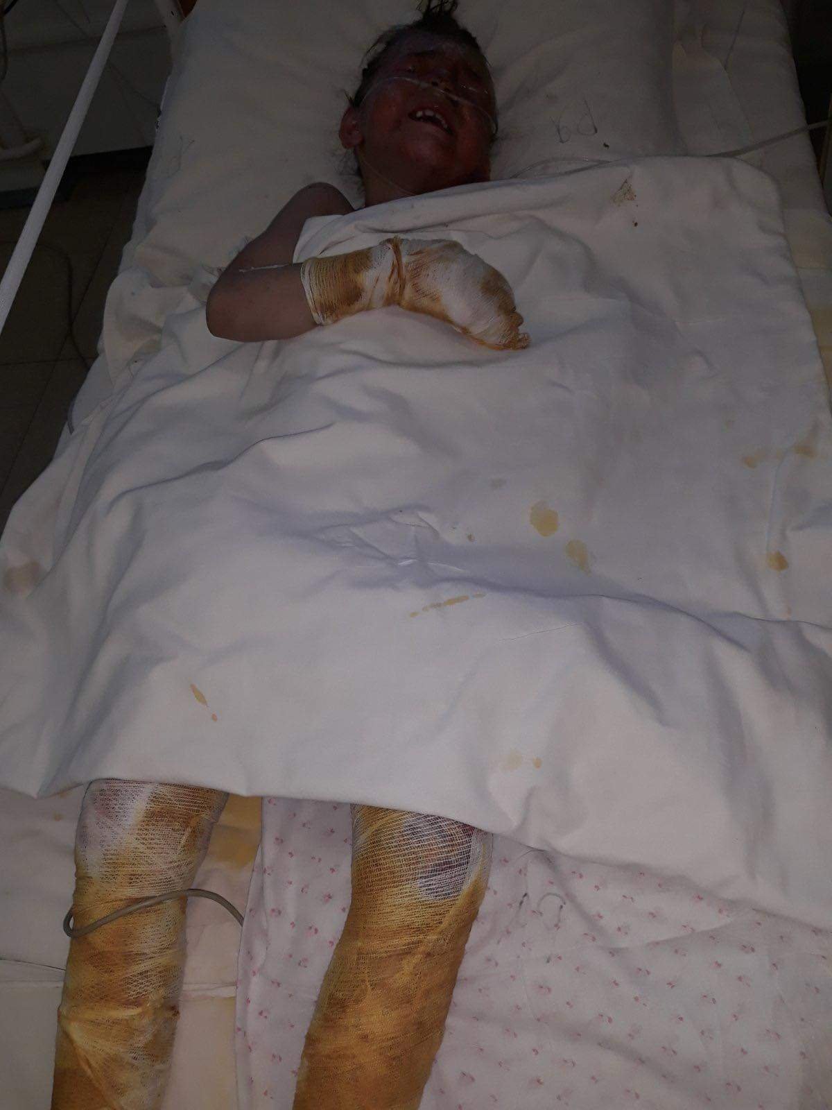 В Днепр доставили 7-летнюю девочку, которая пострадала в пожаре 1