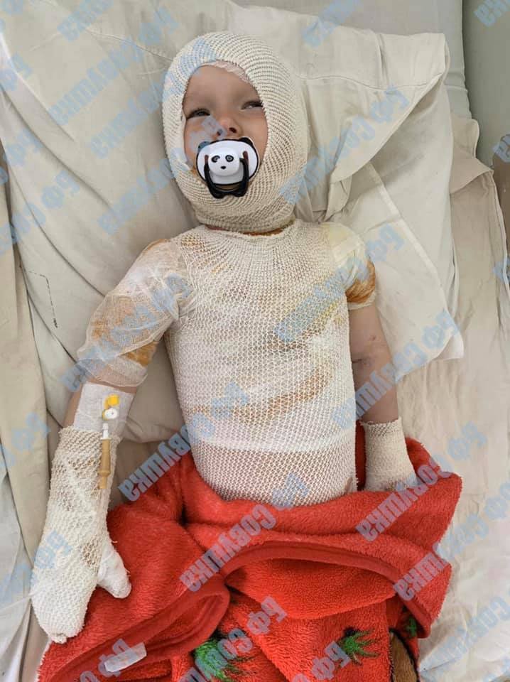 Как себя чувствует 2-летний мальчик из Днепра, опрокинувший на себя кружку с кипятком 1