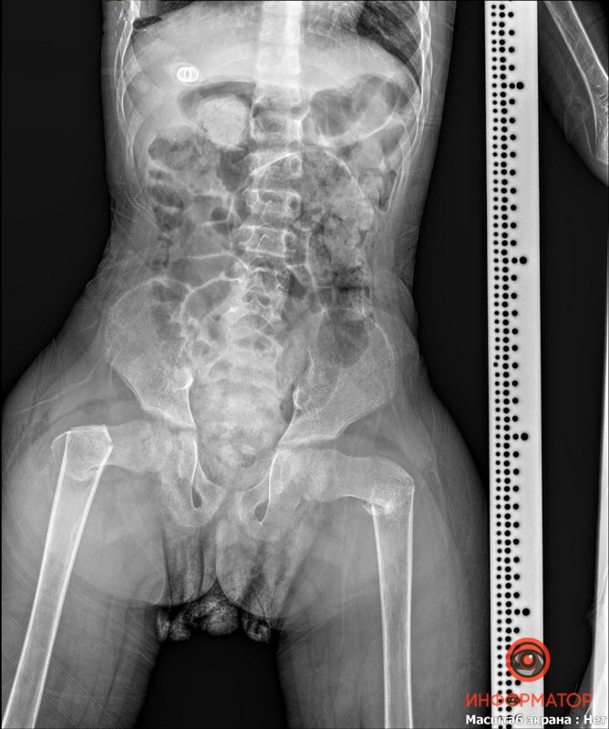 Мальчик сломал 2 шейки бедренной кости