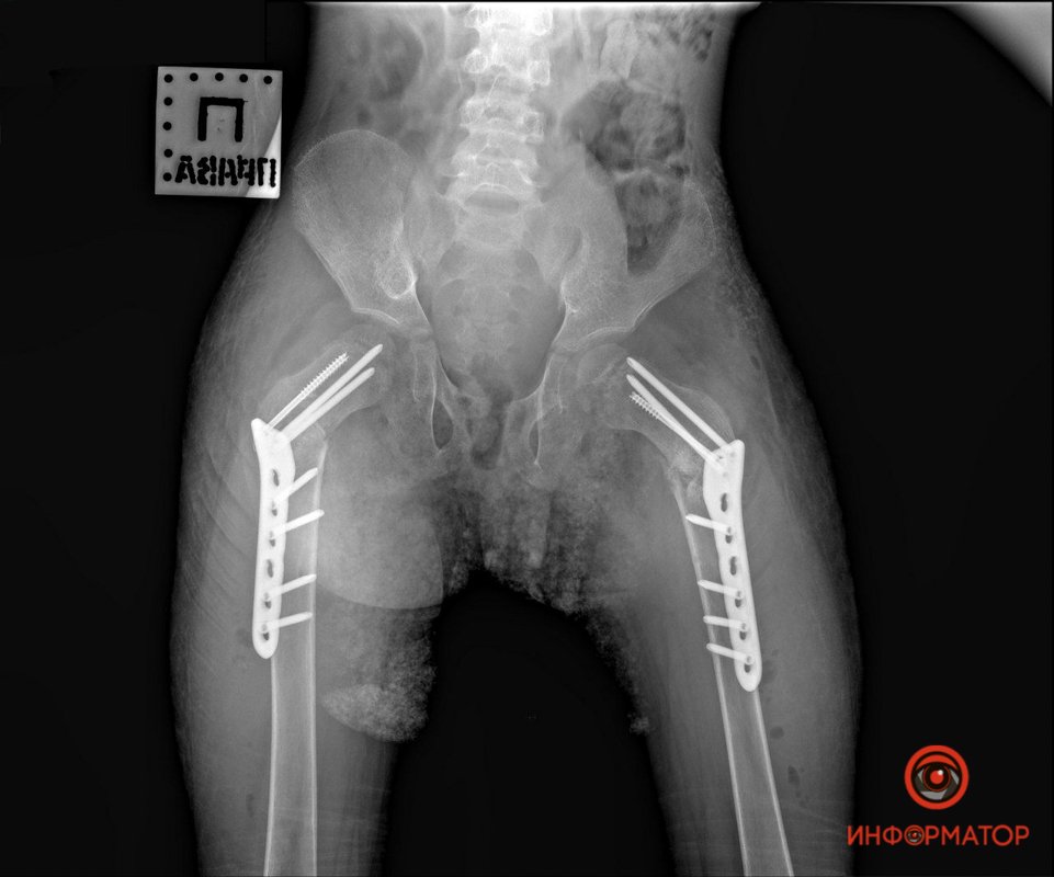 Случай такого лечения - крайне редкий, в мировой литературе есть лишь несколько подобных примеров