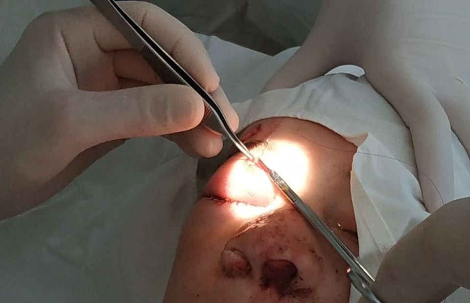 В Днепре на 13-летнего мальчика упала лестница: у ребенка сломан нос и рваные раны на лице 2