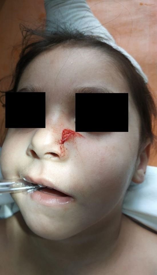 В Днепре 10-летняя девочка упала лицом на острый металлический предмет 1