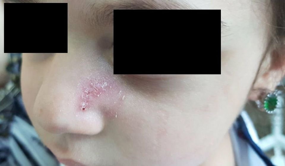 В Днепре 10-летняя девочка упала лицом на острый металлический предмет 2