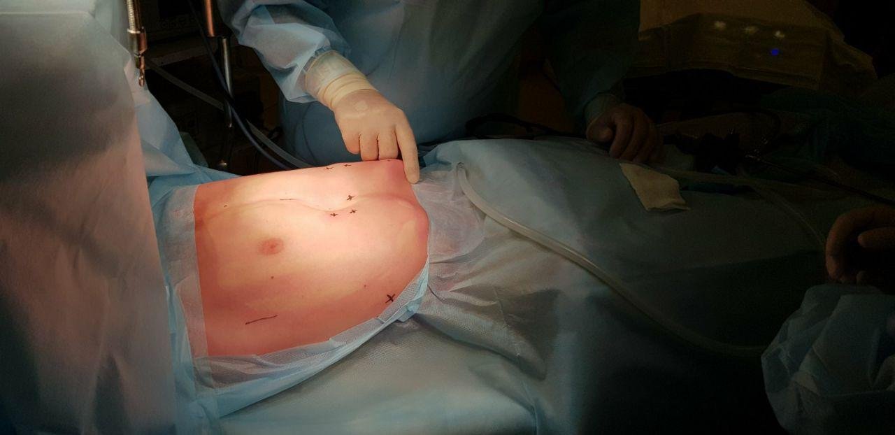 Мальчику провели сложнейшую операцию