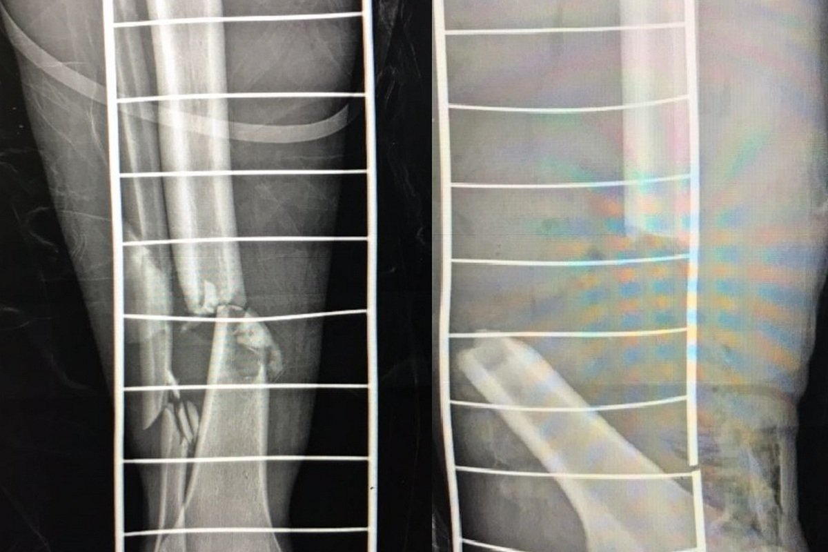 Переломы обеих ног Переломы обеих ног