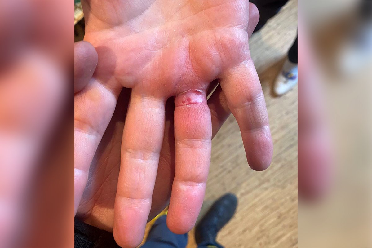 Палец сильно распух, поэтому снять кольцо сама женщина не смогла Палец сильно распух, поэтому снять кольцо сама женщина не смогла