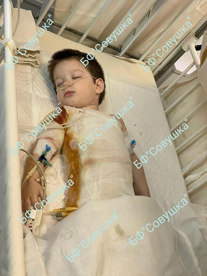 У малыша ожоги 35% тела