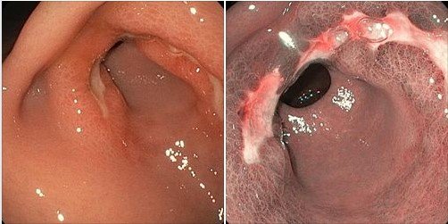 Язва желудка без кровотечения Язва желудка без кровотечения
