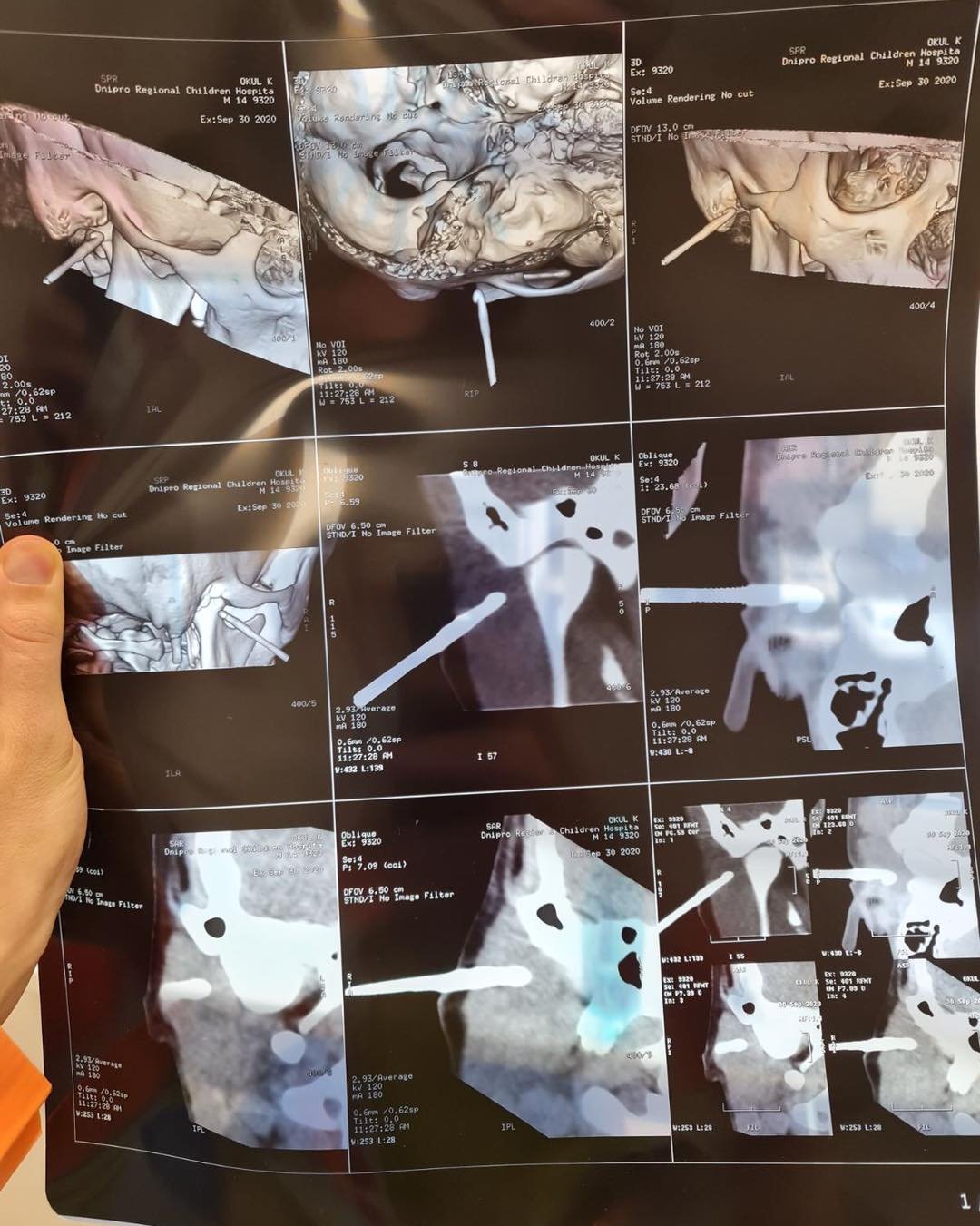 Крючок попал в ухо Крючок попал в ухо