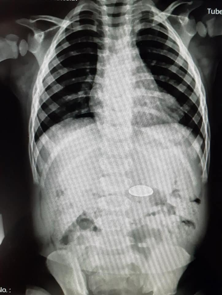 В Днепре в больницу доставили ребенка, проглотившего значок