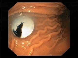 11 декабря в областную детскую клиническую больницу доставили ребенка, который проглотил инородный предмет