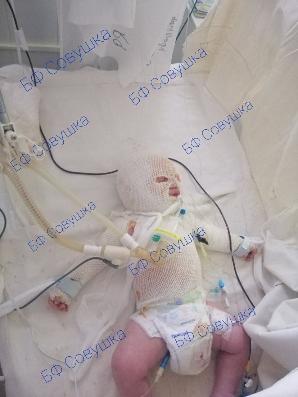 Младенец получил сильные ожоги кипятком Младенец получил сильные ожоги кипятком