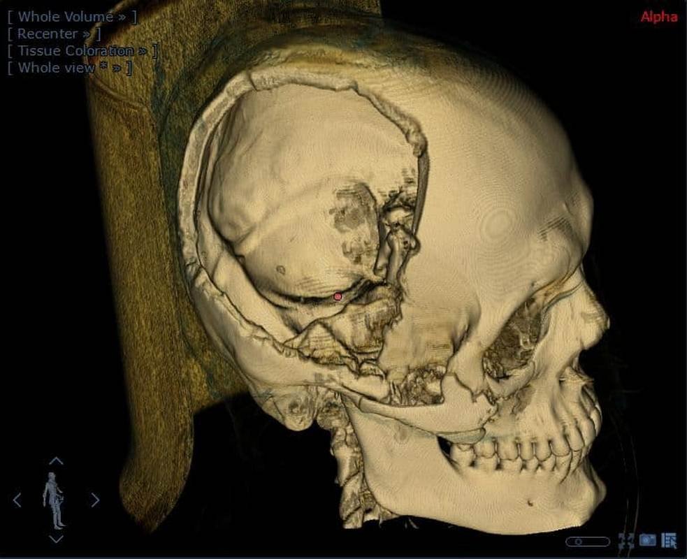 Так выглядит пластика дефекта черепа