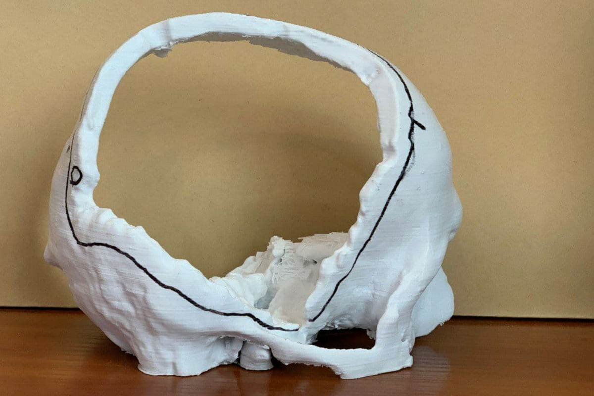 Нужно перекрыть титановой пластиной