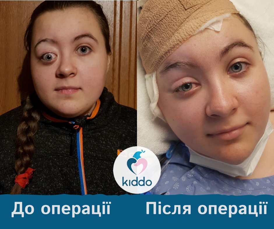 Фонд Kiddo помог 16-летней девочке с папилломой Шнейдера и собирает помощь 16-летнему мальчику с лейкозом 1