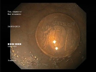 В Днепре 2-летний ребенок съел 10 рублей и 50 турецких курушей 1