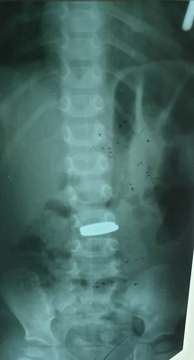 В Днепре 2-летний ребенок съел 10 рублей и 50 турецких курушей 2