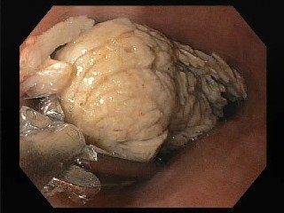 Кусок мяса достали из пищевода