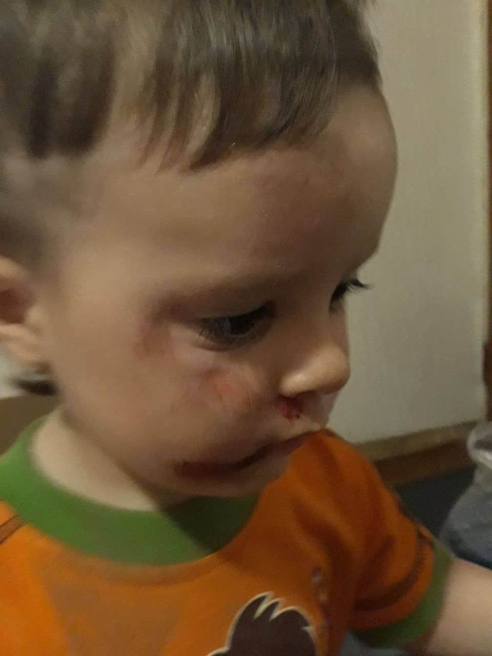 Мальчик упал лицом на асфальт Мальчик упал лицом на асфальт