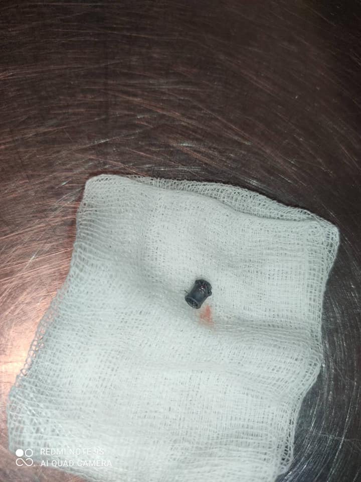 Пулю извлекли