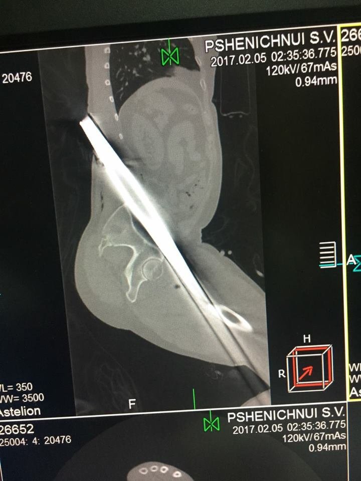 Как в "Пункте назначения": в Днепре спасали парня, которого проткнула железная труба (ФОТО) 1