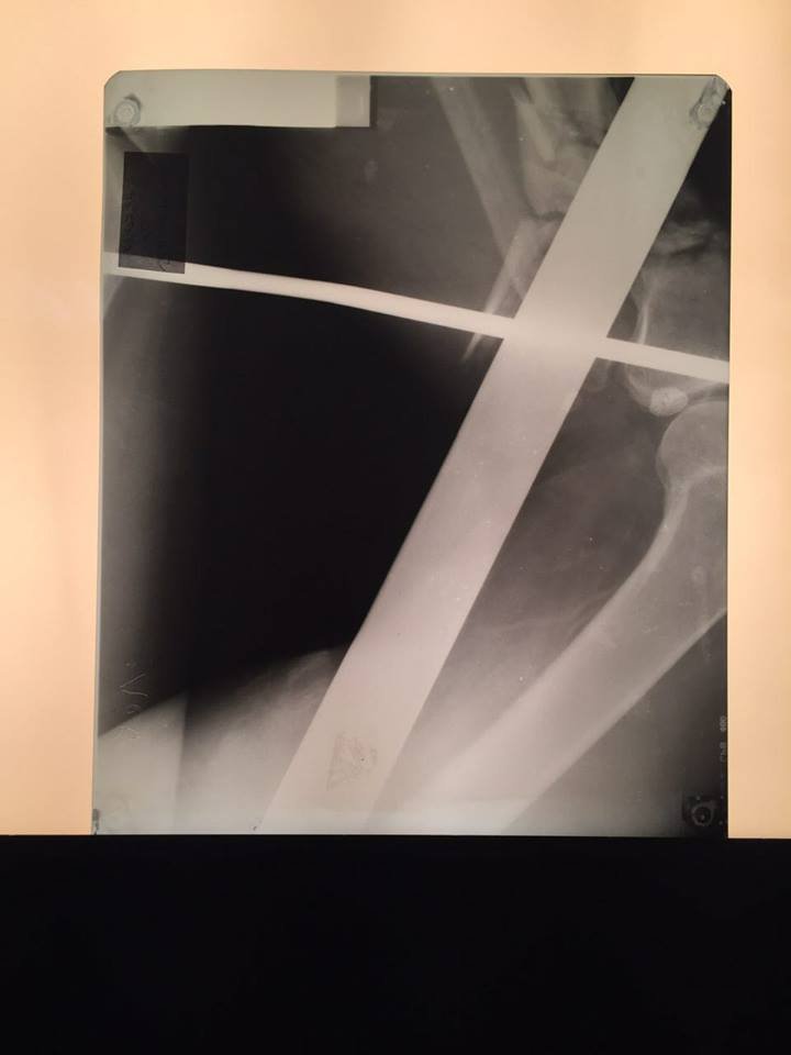 Как в "Пункте назначения": в Днепре спасали парня, которого проткнула железная труба (ФОТО) 2