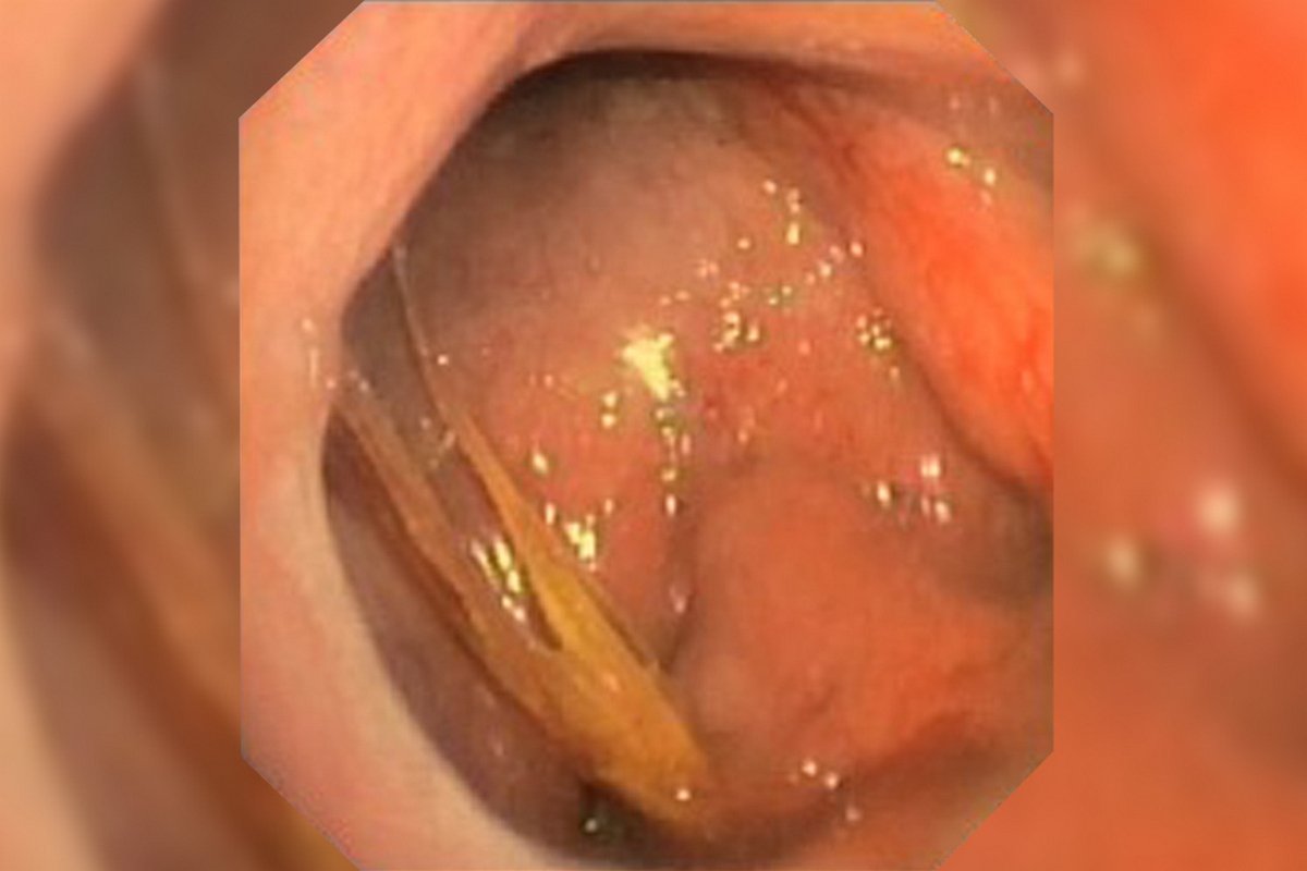 Колосок застрял в носоглотке у мужчины Колосок застрял в носоглотке у мужчины